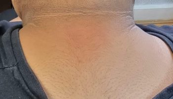 after-3-body-peel.jpg